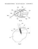 IMPLANT PLACEMENT SYSTEMS, DEVICES AND METHODS diagram and image