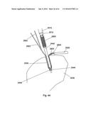 IMPLANT PLACEMENT SYSTEMS, DEVICES AND METHODS diagram and image