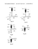 IMPLANT PLACEMENT SYSTEMS, DEVICES AND METHODS diagram and image