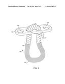 CLOSED LOOP SUTURE FOR ANCHORING TISSUE GRAFTS diagram and image