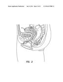 NATURAL ORIFICE SURGERY SYSTEM diagram and image