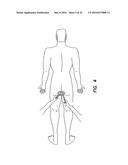 NATURAL ORIFICE SURGERY SYSTEM diagram and image