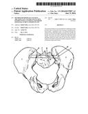 Method for Minimally Invasive Treatment of Unstable Pelvic Ring Injuries     with an Internal Posterior Iliosacral Screw and Bone Plate diagram and image