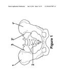 Method for Minimally Invasive Treatment of Unstable Pelvic Ring Injuries     with an Internal Posterior Iliosacral Screw and Bone Plate diagram and image