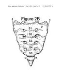 Method for Minimally Invasive Treatment of Unstable Pelvic Ring Injuries     with an Internal Posterior Iliosacral Screw and Bone Plate diagram and image