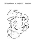 Method for Minimally Invasive Treatment of Unstable Pelvic Ring Injuries     with an Internal Posterior Iliosacral Screw and Bone Plate diagram and image