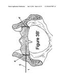 Method for Minimally Invasive Treatment of Unstable Pelvic Ring Injuries     with an Internal Posterior Iliosacral Screw and Bone Plate diagram and image