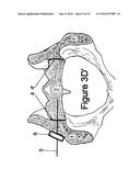 Method for Minimally Invasive Treatment of Unstable Pelvic Ring Injuries     with an Internal Posterior Iliosacral Screw and Bone Plate diagram and image