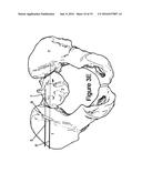 Method for Minimally Invasive Treatment of Unstable Pelvic Ring Injuries     with an Internal Posterior Iliosacral Screw and Bone Plate diagram and image