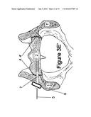 Method for Minimally Invasive Treatment of Unstable Pelvic Ring Injuries     with an Internal Posterior Iliosacral Screw and Bone Plate diagram and image