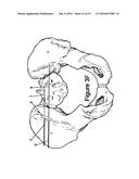 Method for Minimally Invasive Treatment of Unstable Pelvic Ring Injuries     with an Internal Posterior Iliosacral Screw and Bone Plate diagram and image