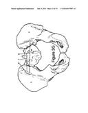 Method for Minimally Invasive Treatment of Unstable Pelvic Ring Injuries     with an Internal Posterior Iliosacral Screw and Bone Plate diagram and image