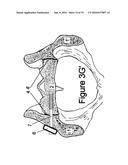 Method for Minimally Invasive Treatment of Unstable Pelvic Ring Injuries     with an Internal Posterior Iliosacral Screw and Bone Plate diagram and image