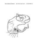 Method for Minimally Invasive Treatment of Unstable Pelvic Ring Injuries     with an Internal Posterior Iliosacral Screw and Bone Plate diagram and image