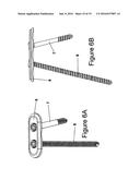 Method for Minimally Invasive Treatment of Unstable Pelvic Ring Injuries     with an Internal Posterior Iliosacral Screw and Bone Plate diagram and image