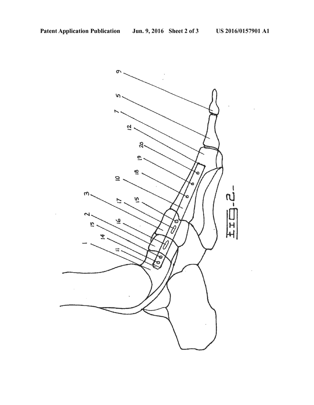 Method and Apparatus for Repairing the Mid-Foot Region Via and     Intramedullary Nail - diagram, schematic, and image 03