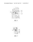 BONE PLATE FOR REDUCING ANGULAR BONE DEFORMITY AND METHOD OF USING diagram and image