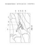 BONE PLATE FOR REDUCING ANGULAR BONE DEFORMITY AND METHOD OF USING diagram and image