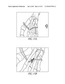 BONE PLATE FOR REDUCING ANGULAR BONE DEFORMITY AND METHOD OF USING diagram and image