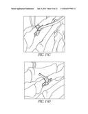 BONE PLATE FOR REDUCING ANGULAR BONE DEFORMITY AND METHOD OF USING diagram and image