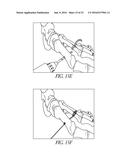 BONE PLATE FOR REDUCING ANGULAR BONE DEFORMITY AND METHOD OF USING diagram and image