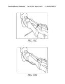 BONE PLATE FOR REDUCING ANGULAR BONE DEFORMITY AND METHOD OF USING diagram and image