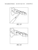 BONE PLATE FOR REDUCING ANGULAR BONE DEFORMITY AND METHOD OF USING diagram and image