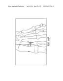 BONE PLATE FOR REDUCING ANGULAR BONE DEFORMITY AND METHOD OF USING diagram and image