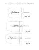 BONE IMPLANTS FOR THE TREATMENT OF INFECTION diagram and image