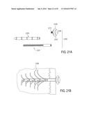 BONE IMPLANTS FOR THE TREATMENT OF INFECTION diagram and image