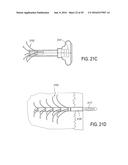 BONE IMPLANTS FOR THE TREATMENT OF INFECTION diagram and image