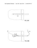 BONE IMPLANTS FOR THE TREATMENT OF INFECTION diagram and image