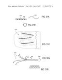 BONE IMPLANTS FOR THE TREATMENT OF INFECTION diagram and image