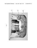 METHOD FOR MANUFACTURING SURGICAL GUIDE AND CROWN, ABUTMENT IN MOUTH FOR     DENTAL IMPLANT diagram and image