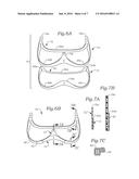 PROSTHETIC MITRAL VALVE diagram and image