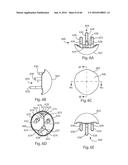 HUMERAL ARTHROPLASTY diagram and image