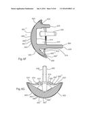 HUMERAL ARTHROPLASTY diagram and image