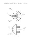 HUMERAL ARTHROPLASTY diagram and image