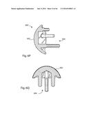 HUMERAL ARTHROPLASTY diagram and image