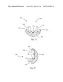 HUMERAL ARTHROPLASTY diagram and image