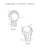 HUMERAL ARTHROPLASTY diagram and image