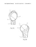 HUMERAL ARTHROPLASTY diagram and image