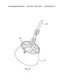 HUMERAL ARTHROPLASTY diagram and image