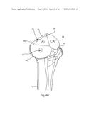 HUMERAL ARTHROPLASTY diagram and image