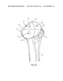 HUMERAL ARTHROPLASTY diagram and image