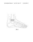 ATTACHMENTS FOR ORTHOPEDIC IMPLANTS diagram and image