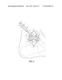 ATTACHMENTS FOR ORTHOPEDIC IMPLANTS diagram and image