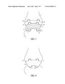 ATTACHMENTS FOR ORTHOPEDIC IMPLANTS diagram and image