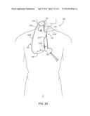 Systems And Methods For Treating A Carotid Artery diagram and image