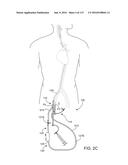 Systems And Methods For Treating A Carotid Artery diagram and image